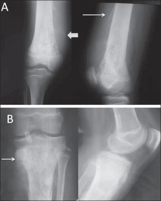Two radiographic views of an adolescent knee showing an aggressive mixed density lesion in the metaphysis.