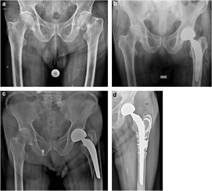 Serial hip radiographs showing Vancouver B2 fracture and long stem revision