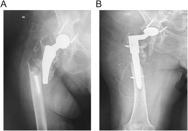 Radiographs showing Vancouver B3 bone loss and B2 long stem reconstruction