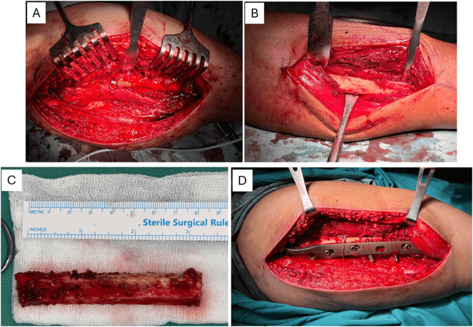 Operative reconstruction of comminuted periprosthetic femur fracture with fibular strut cable and claw plate