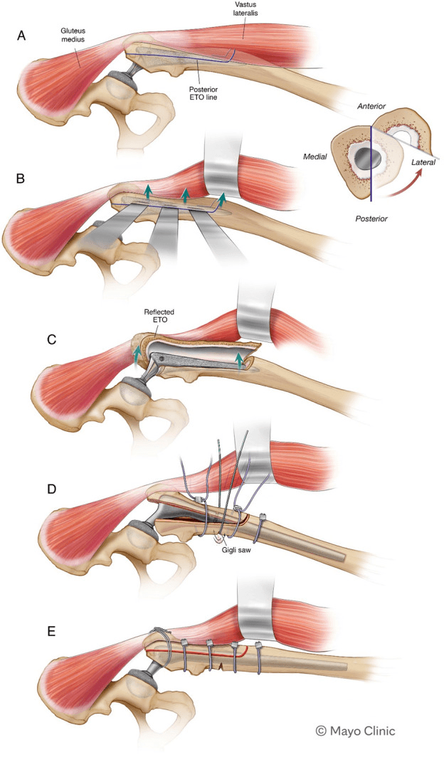 Technical diagrams of extended trochanteric osteotomy with medial reduction corticotomy