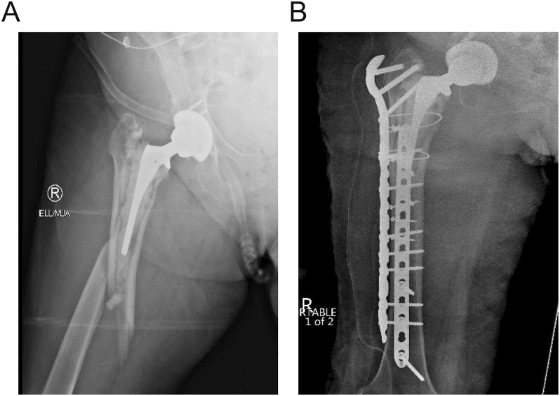 Preoperative Vancouver B2 fracture and postoperative orthogonal plate fixation in a frail patient