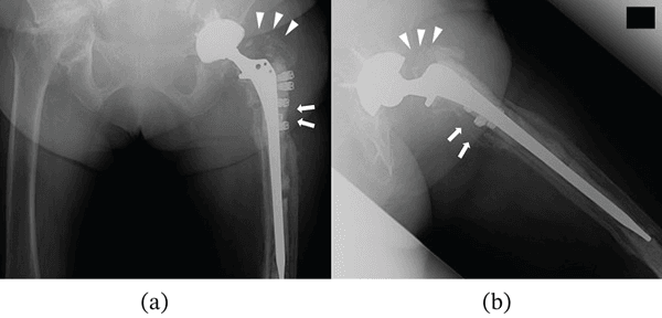 Hip radiographs showing infected proximal femoral osteolysis and loosened cerclage wires
