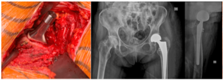 Intraoperative calcar fracture screw fixation with six month radiographs
