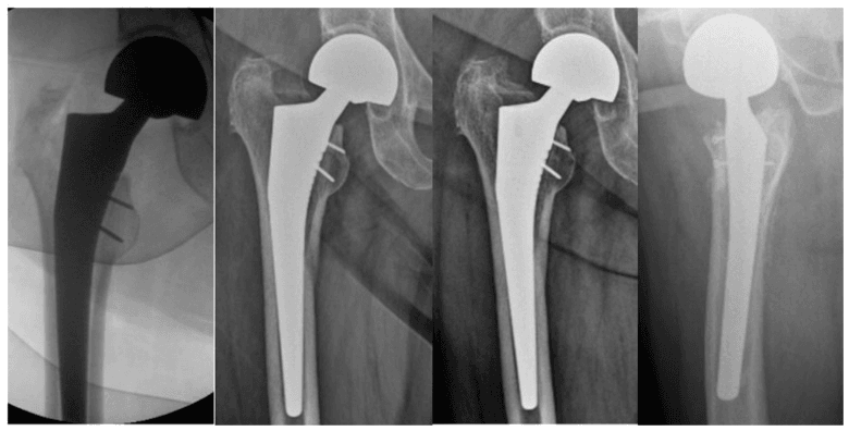 Intraoperative calcar fracture fixation with serial radiographs showing subsidence and healing