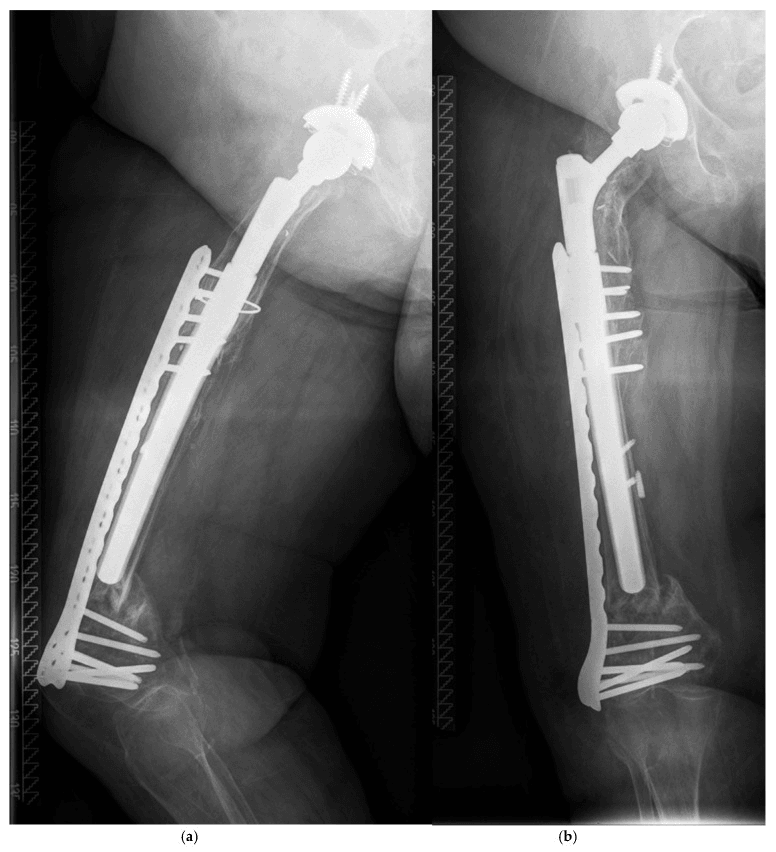 Type C periprosthetic femur fracture plate fixation with subsequent collapse