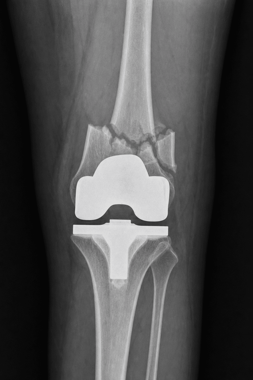 AP knee radiograph showing a supracondylar distal femur fracture above a total knee replacement