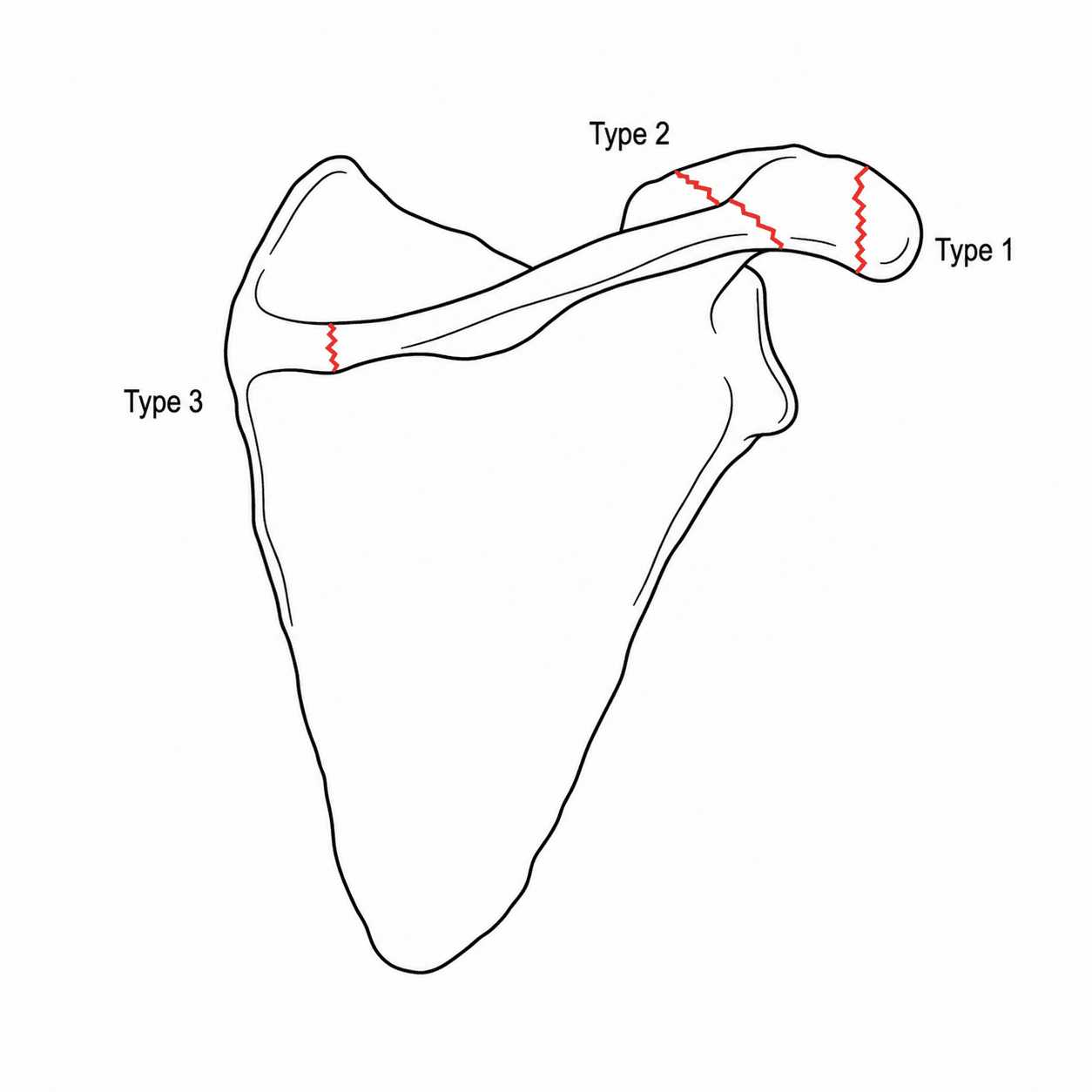 Posterior view diagram of the scapula and acromion showing Levy type 1, 2 and 3 fracture lines