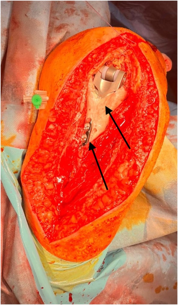 Intraoperative posterior elbow exposure with humeral allograft-prosthesis composite, compression plate and protected nerves