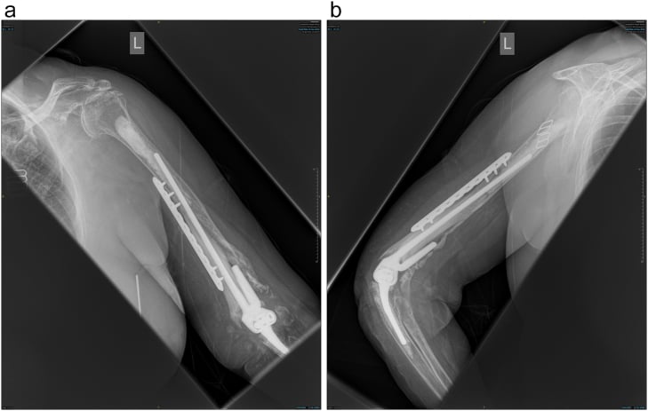 Six-month elbow radiographs showing union of a humeral allograft-prosthesis composite and stable TEA stem