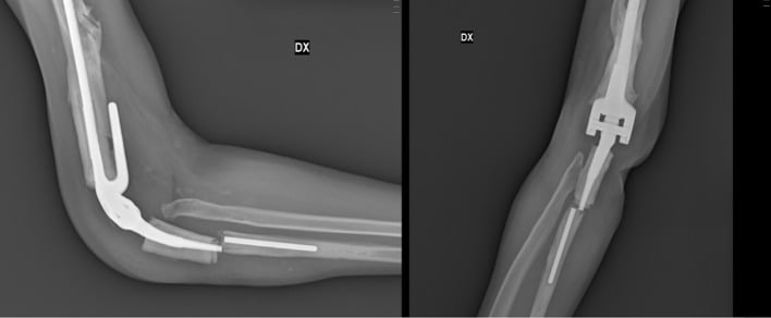 Elbow radiographs showing a periprosthetic ulnar fracture with fracture of a Coonrad-Morrey stem