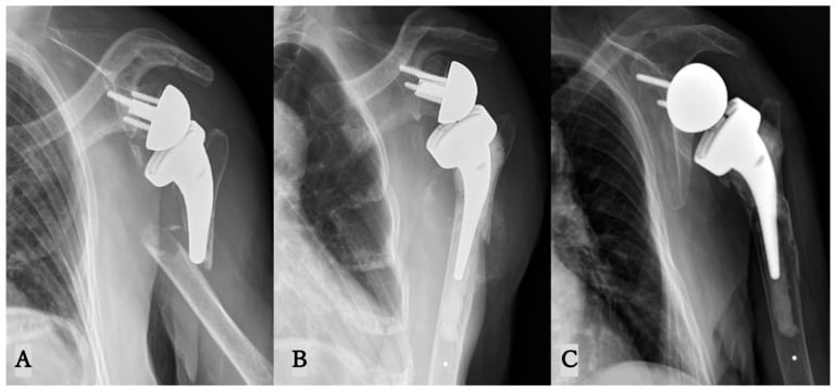 Three radiographs showing fracture, cemented long-stem conversion and union after reverse shoulder arthroplasty