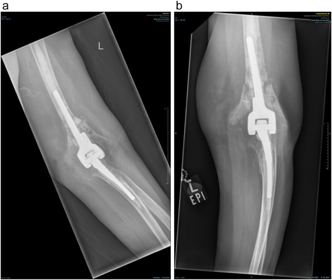 AP and lateral elbow radiographs showing humeral component loosening with a periprosthetic fracture and severe bone loss