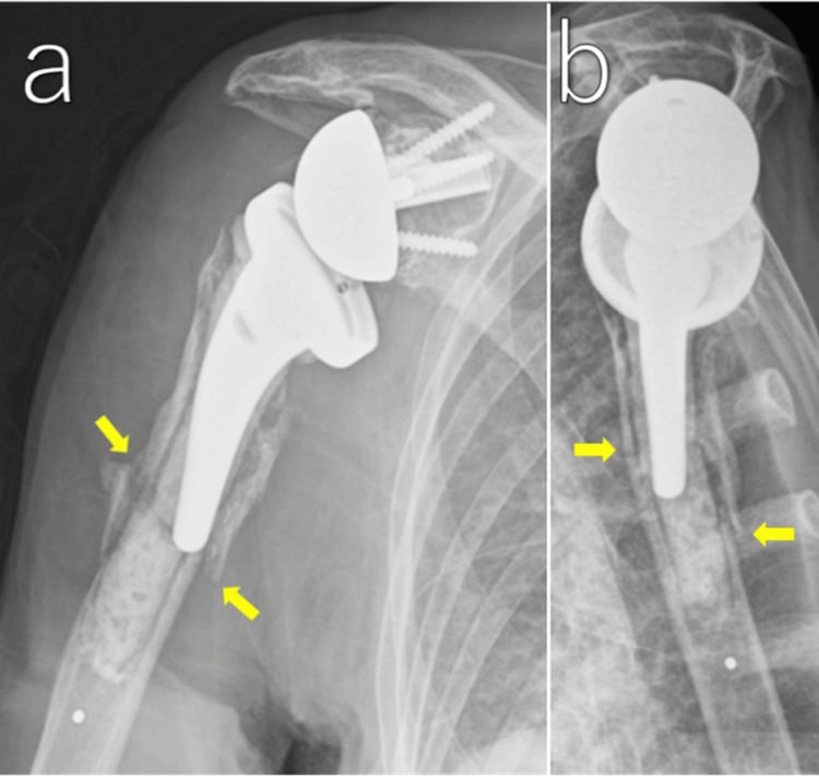 AP and scapular-Y radiographs showing a minimally displaced transverse fracture at the humeral stem tip