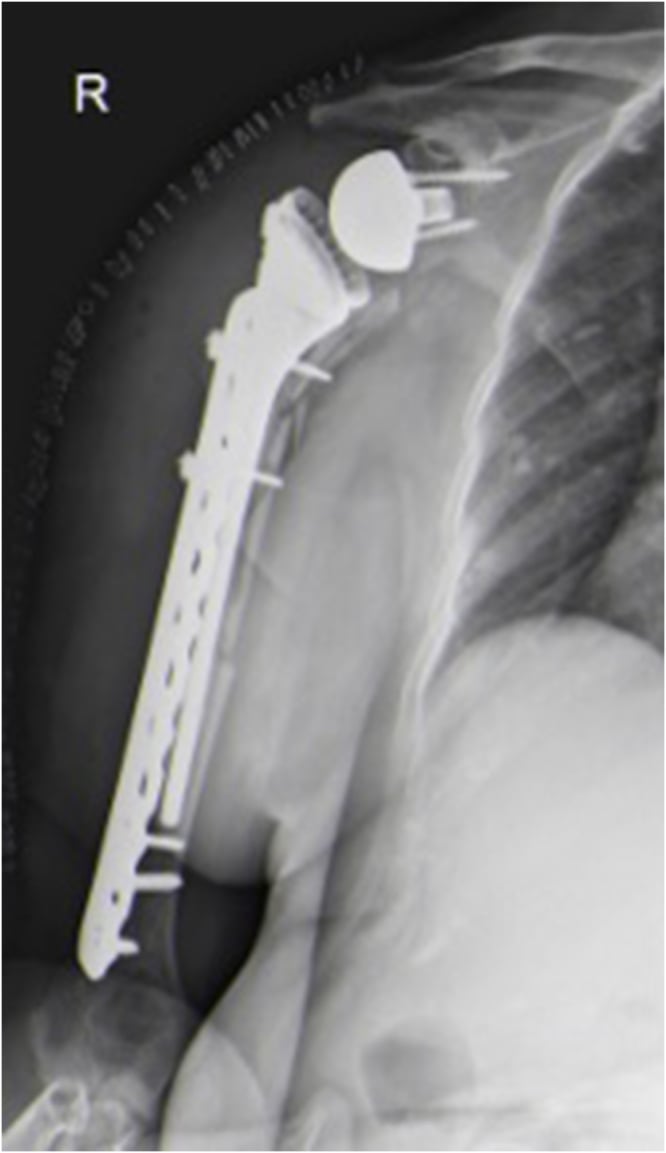 Postoperative shoulder radiograph after ORIF and long-stem revision for a comminuted type B fracture