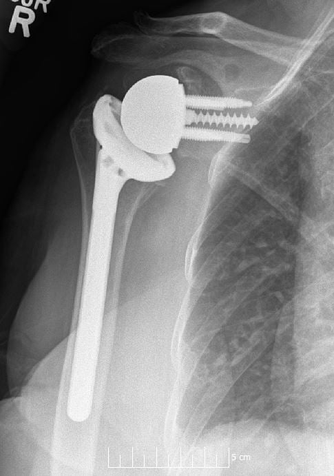 AP radiograph of a reverse total shoulder arthroplasty showing the glenosphere and humeral stem