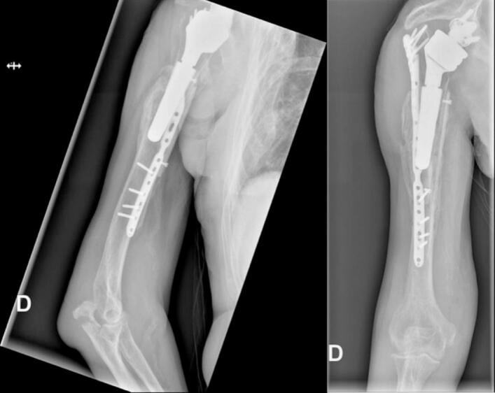 Six-month radiographs showing union after revision ORIF and fibular strut augmentation