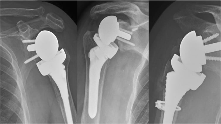 Radiographic examples of acromial stress fracture, glenoid loosening and intraoperative humeral fracture after shoulder arthroplasty