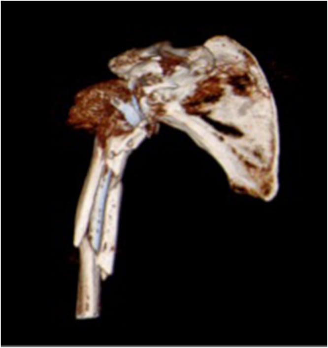 Three-dimensional CT reconstruction of a comminuted Wright-Cofield type B periprosthetic humeral fracture