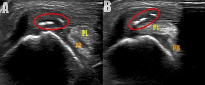 Ultrasound scans of the peroneus brevis and longus tendons showing subluxation