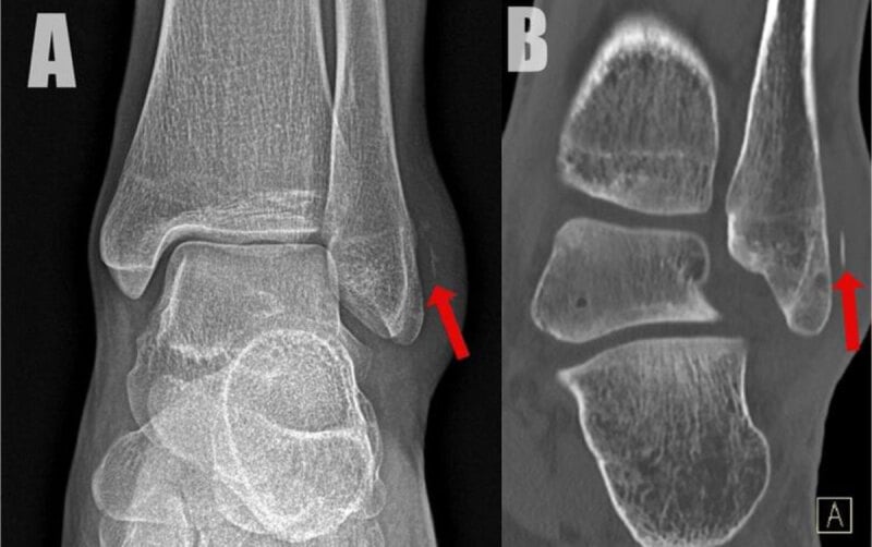 AP radiograph and coronal CT demonstrating the peroneal fleck sign of superior peroneal retinaculum avulsion