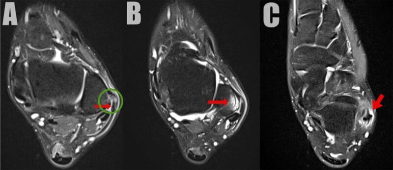 Axial T1, T2, and PD MRI views demonstrating a longitudinal split tear of the peroneus brevis tendon