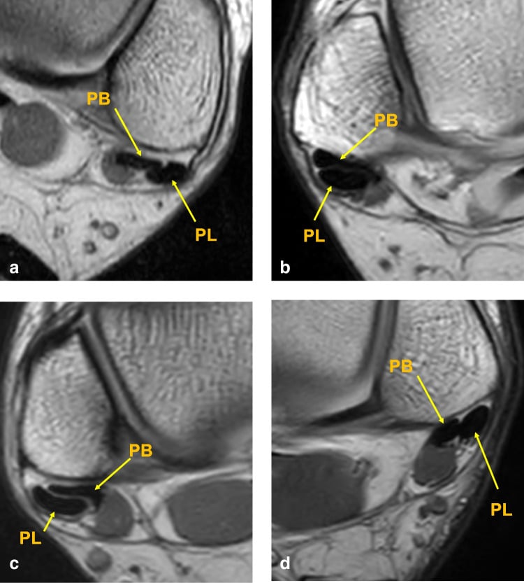 Axial proton density MRI illustrating peroneus brevis and longus tendon split tear morphology