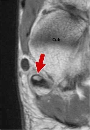 Coronal T1 MRI demonstrating os peroneum accessory ossicle at the cuboid notch