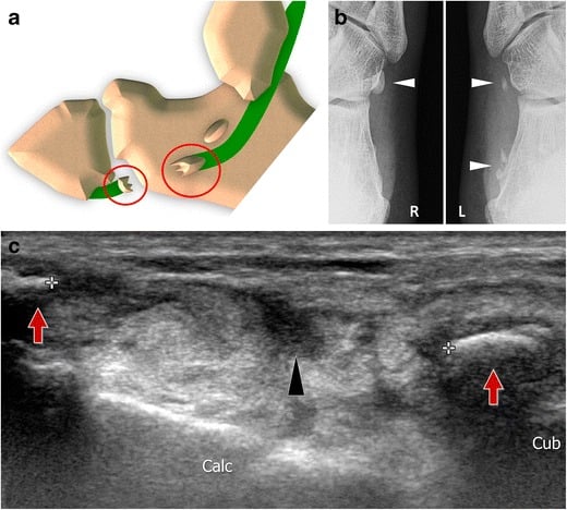 Anatomical diagram, radiographs, and ultrasound demonstrating Type II peroneus longus tendon tear