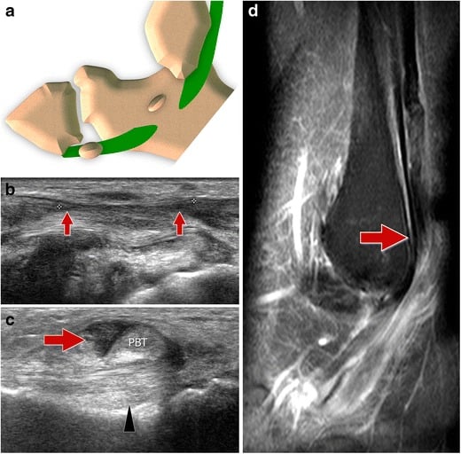 Anatomical diagram and longitudinal ultrasound scan demonstrating Type I peroneus longus tendon tear