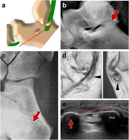 Anatomical diagram, radiographs, CT, and ultrasound demonstrating Type III peroneus longus tendon tear