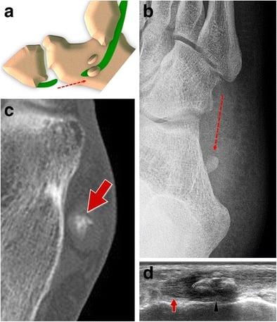 Anatomical diagram, radiograph, CT, and ultrasound demonstrating Type III peroneus longus tear