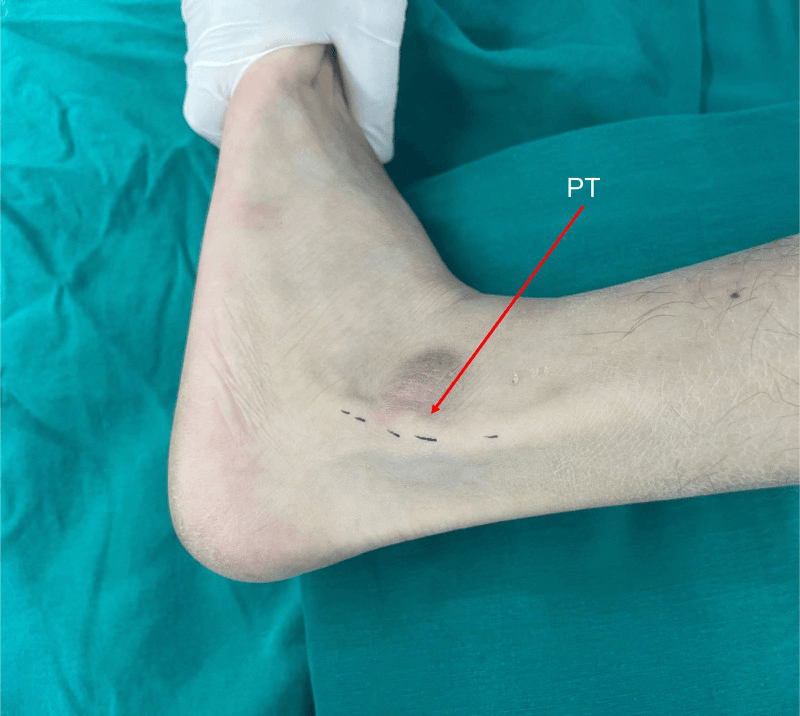 Lateral ankle photograph with an arrow labelled PT on a displaced peroneal tendon visible under the skin