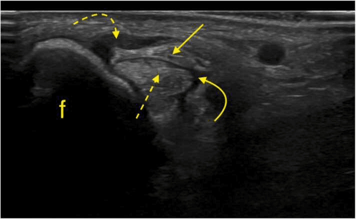 Ultrasound beside the fibula, labelled f, with arrows marking an unstable peroneal tendon relationship