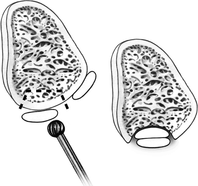 Two axial diagrams of fibular groove deepening: a burr with a dashed outline of the bone to be removed, then the deepened groove