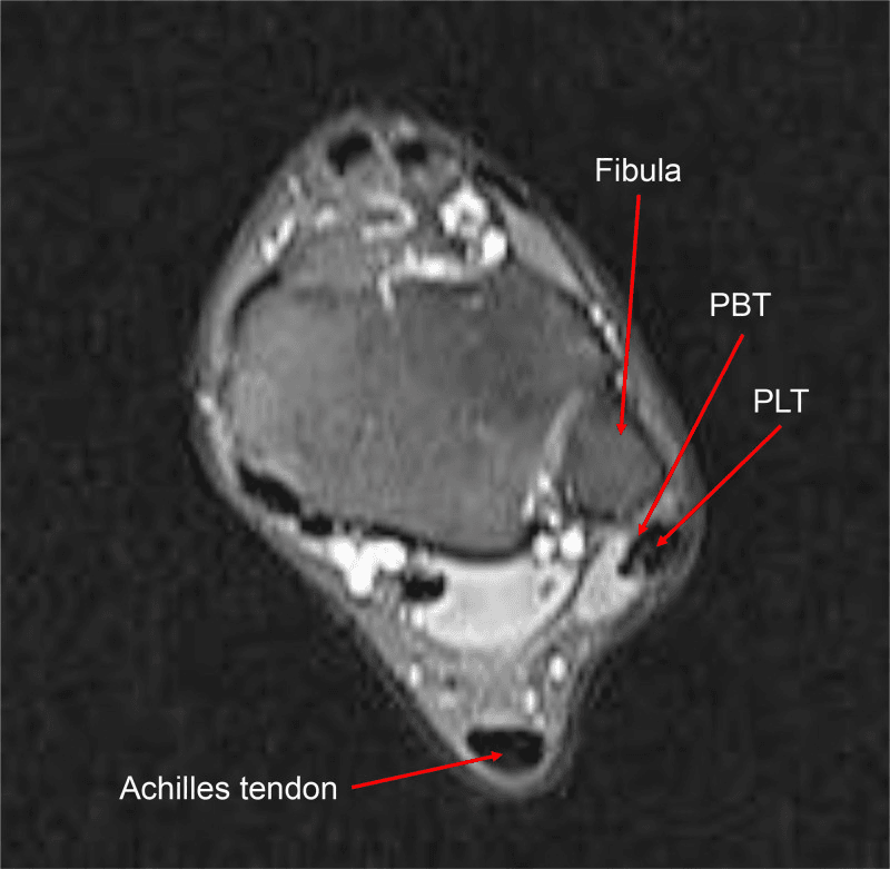 Axial ankle MRI with labelled fibula, peroneus brevis, peroneus longus and Achilles tendon in frank peroneal instability