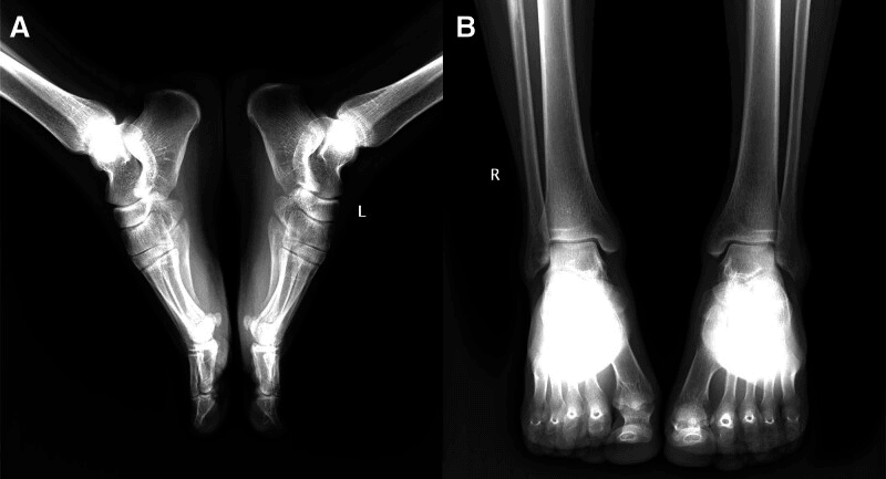 Normal initial ankle radiographs in a patient with chronic peroneal tendon subluxation