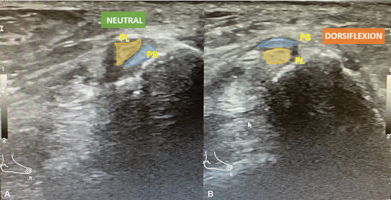 Neutral and dorsiflexion ultrasound of intrasheath peroneal tendon subluxation