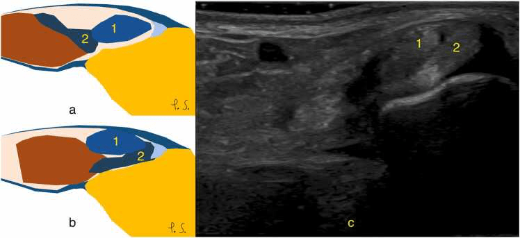 Two schematic panels, a and b, and an ultrasound panel, c, of intrasheath peroneal tendon instability with the tendons numbered 1 and 2