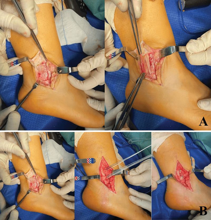 Operative sequence of superior peroneal retinaculum flap retinaculoplasty