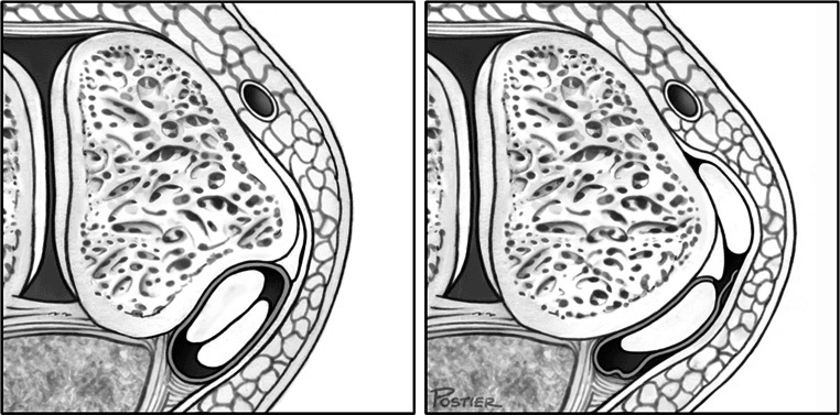 Two axial schematic panels comparing peroneal tendons within the retromalleolar tunnel with a tendon displaced onto the lateral surface of the malleolus