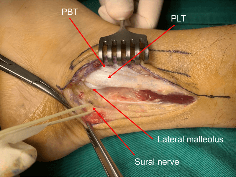 Operative exposure of sural nerve peroneus brevis and peroneus longus at lateral ankle