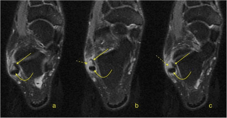 MRI series showing longitudinal peroneus brevis split tear