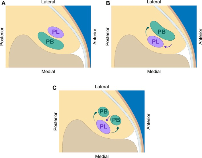Raikin Type A and Type B intrasheath peroneal tendon subluxation schematic
