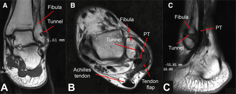 MRI panels A to C after tendon flap reconstruction for peroneal instability, labelling the fibula, fibular tunnel and peroneal tendon