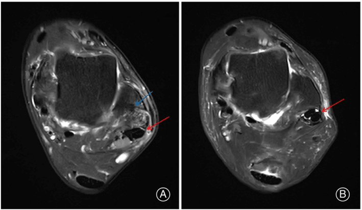Two axial MRI panels, A and B, from a case of superior peroneal retinaculum repair with a suture anchor, with arrows at the lateral fibula