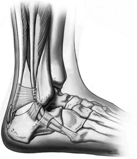 Lateral ankle illustration after superior peroneal retinaculum repair