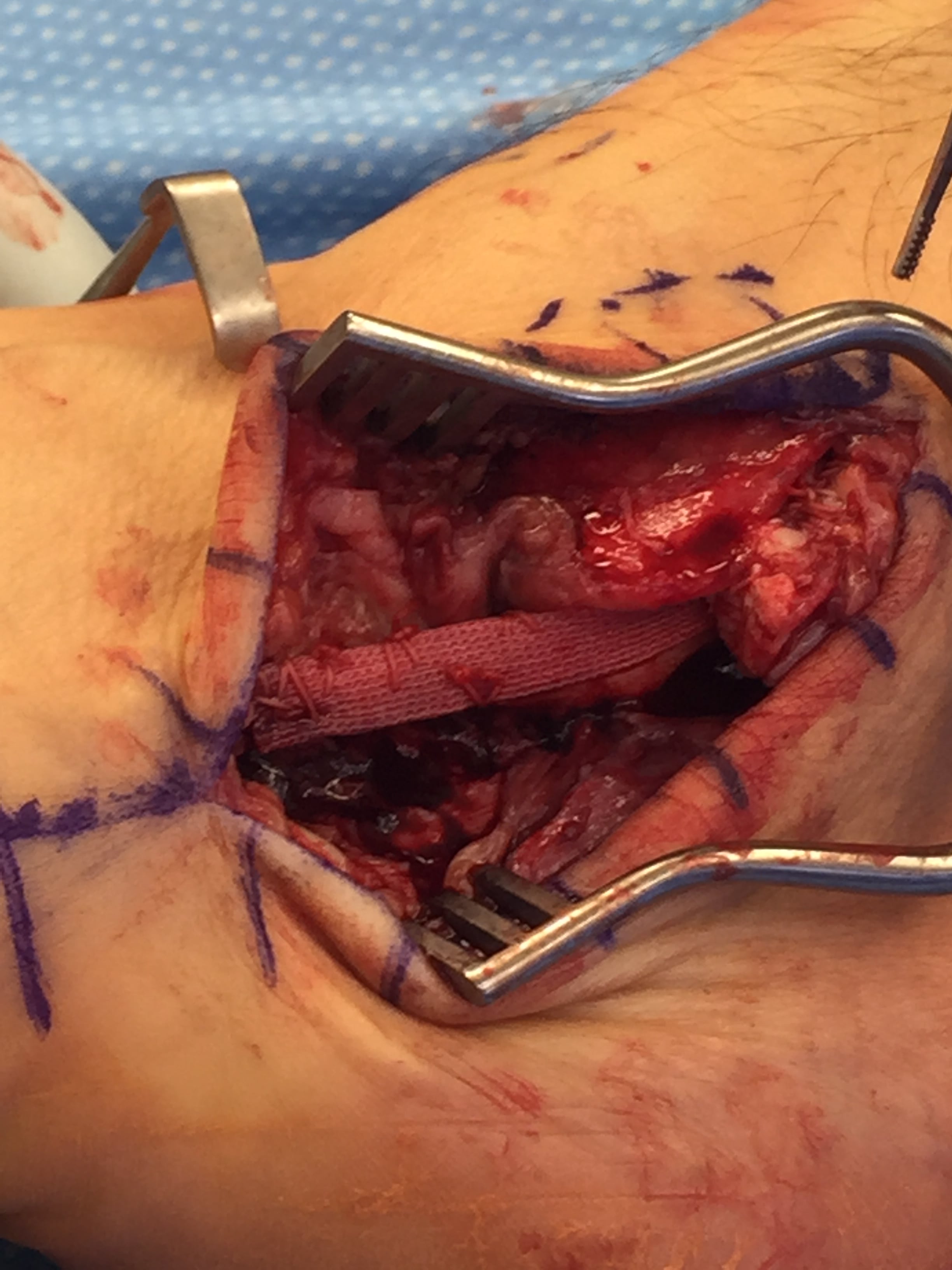Operative lateral-ankle exposure during peroneal tendon reconstruction