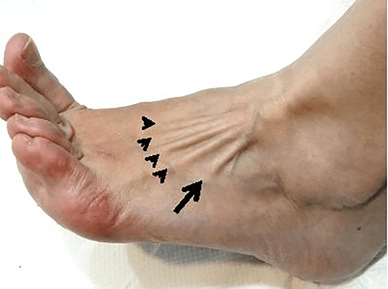 Dorsolateral photograph of a left foot and ankle with an arrow on the fibularis tertius tendon and arrowheads on the extensor digitorum longus tendons.