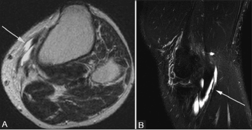 Pes anserine bursitis anatomical region image